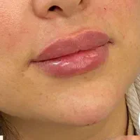 تزریق ژل،بوتاکس،خال برداری،مزوی مو و صورت|خدمات آرایشگری و زیبایی|بندر کنگان, |دیوار