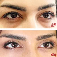 عمل بلفاروپلاستی درمان افتادگی پلک توسط متخصص چشم|خدمات آرایشگری و زیبایی|یاسوج, |دیوار