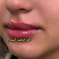 بوتاکس مصپورت فقط۴۹۰ کلینیک زیبایی دکتر فرشیدکریمی|خدمات آرایشگری و زیبایی|کرمانشاه, |دیوار