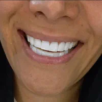 کامپوزیت زیبایی دندانپزشکی|خدمات آرایشگری و زیبایی|یاسوج, |دیوار