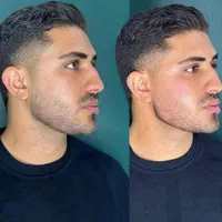 کلینیک ژل.فیلر.زاویه سازی.مادلینگ.فول فیس اقایان|خدمات آرایشگری و زیبایی|مشهد, سناباد|دیوار