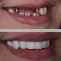 مرکز جراحی ایمپلنت (دنتال ولیعصر )|خدمات آرایشگری و زیبایی|تهران, میدان ولیعصر|دیوار