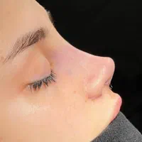 عمل جراحی زیبایی بینی اندام گوش لیفت صورت