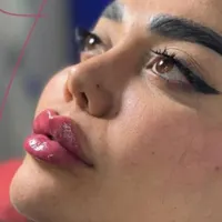 ژل بوتاکس آنزیم مطب پزشک|خدمات آرایشگری و زیبایی|کرج, عظیمیه|دیوار