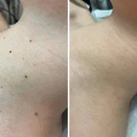 خال برداری و رفع انواع خال و خالبرداری|خدمات آرایشگری و زیبایی|اهواز, کیانپارس |دیوار