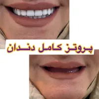 دندان مصنوعی/ دست دندان/ ژله ای/ چکی|خدمات آرایشگری و زیبایی|کرج, چهارصد دستگاه|دیوار