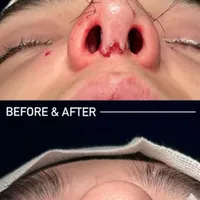 عمل جراحی بینی با دستگاه پیزو 22/لیفت صورت/پلک|خدمات آرایشگری و زیبایی|تهران, توانیر|دیوار
