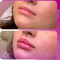 آموزش تزریق فیلر،بوتاکس و لیزر توسط پزشک
