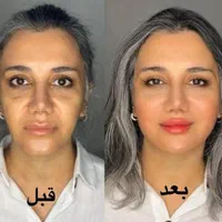 آموزش و خدمات ژل فیلر بوتاکس هایفو توسط پزشک مجرب