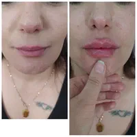 لیزرمو تزریق ژل و بوتاکس پاکسازی برداشت خال|خدمات آرایشگری و زیبایی|شیراز, ریاستی|دیوار