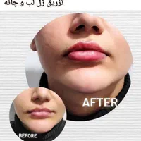 جشنواره تزریق ژل و بوتاکس و PRP برداشت خال|خدمات آرایشگری و زیبایی|تهران, بلوار کشاورز|دیوار