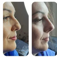 لیفت بینی بانخ|خدمات آرایشگری و زیبایی|تبریز, |دیوار