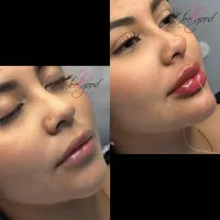 آموزش فیلر و بوتاکس صد درصد یادگیری