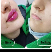 جشنواره پاییزه تزریق ژل وبوتاکس توسط پزشک متخصص|خدمات آرایشگری و زیبایی|بندرعباس, |دیوار