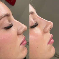 آنزیم ترکیبی بینی گوشتی،لیفت بینی،ژل لب،مزوتراپی|خدمات آرایشگری و زیبایی|تهران, سعادت‌آباد|دیوار