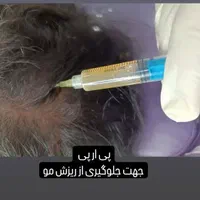 فیلر هایفو لاغری چربی لیزر پی آر پی مزو نخ|خدمات آرایشگری و زیبایی|تبریز, |دیوار