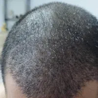 کاشت مو ۳ روزه -کاشت ابرو بدون جراحی و باجراحی