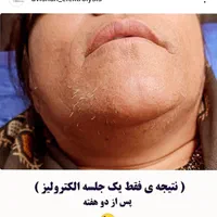 تخفیف الکترولیز،(×لیزر نیست) حذف دائم موهای زائد|خدمات آرایشگری و زیبایی|یاسوج, |دیوار