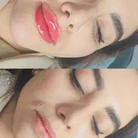 جشنواره فیلر ژل بوتاکس prpمزوتراپی لیزر توسط پزشک|خدمات آرایشگری و زیبایی|کرمان, |دیوار