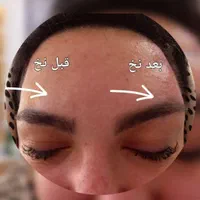 لیفت با نخ و جوانسازی با نخ با قیمت عالی توسط پزشک|خدمات آرایشگری و زیبایی|اسلام‌شهر, باغ فیض|دیوار