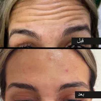 چربی بوتاکس ساکشن غبغب ژل مزو PRPتوسط پزشک مجرب|خدمات آرایشگری و زیبایی|زاهدان, |دیوار