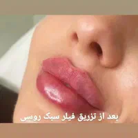 تزریق ژل وبوتاکس|خدمات آرایشگری و زیبایی|گلبهار, |دیوار