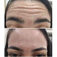 کلینیک پوست و زیبایی ژل لب/فیلرگونه/زاویه/بوتاکس|خدمات آرایشگری و زیبایی|قم, صفائیه|دیوار