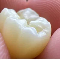 استخدام نیرو  (پودر گذار )در دندانسازی