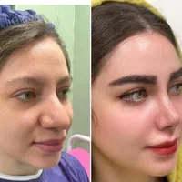 عمل جراحی بینی/ ترمیم/ لیفت کل صورت /پلک تهران|خدمات آرایشگری و زیبایی|تهران, میدان ولیعصر|دیوار