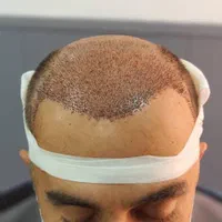 کاشت مو ۳ روزه -کاشت ابرو بدون جراحی و باجراحی|خدمات آرایشگری و زیبایی|خرم‌آباد, |دیوار