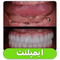 مرکز تخصصی ایمپلنت، مطب دندانپزشکی باقیمتی کم نظیر|خدمات آرایشگری و زیبایی|شیراز, قصرالدشت|دیوار