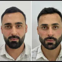 تزریق ژل و بوتاکس و آموزش آزاد و با پترو
