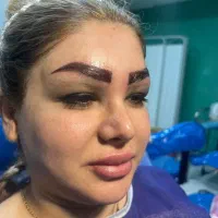 کاشت مو و شقیقه