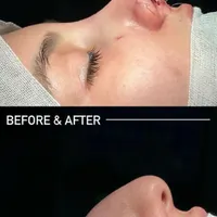 عمل جراحی بینی با دستگاه پیزو 22/لیفت صورت/پلک|خدمات آرایشگری و زیبایی|تهران, توانیر|دیوار
