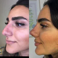 بوتاکس فیلر پی آر پی مزوتراپی زگیل تناسلی|خدمات آرایشگری و زیبایی|تبریز, |دیوار