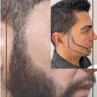 کاشت مو کاشت ابرو کاشت ریش تارکوب|خدمات آرایشگری و زیبایی|هشتگرد, |دیوار