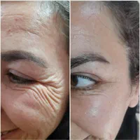 افر ویژه‌ی فیلر/بوتاکس/prpبا قیمت باورنکردنی|خدمات آرایشگری و زیبایی|تهران, دروازه شمیران|دیوار
