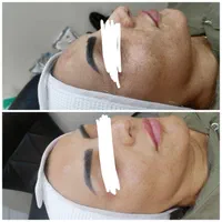 خدمات تخصصی پاکسازی فیشال صورت و بدن با دستگاه|خدمات آرایشگری و زیبایی|شاهین‌شهر, عطار|دیوار