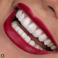 ایمپلنت دندان دندانپزشکی کامپوزیت لمینت کلیه خدمات|خدمات آرایشگری و زیبایی|شهرکرد, |دیوار