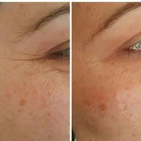 ژل لب هایفولیفت نخ زاویه چانه بوتاکس فیلربینی لیزر|خدمات آرایشگری و زیبایی|مشهد, فرهنگ|دیوار