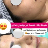 میکرونیدلینگ کربوکسی تراپی co2 (سفید کننده پوست )