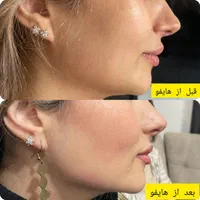 لیزر موی زائدفوق قوی الکساندرایت امریکایی درمهرشهر|خدمات آرایشگری و زیبایی|کرج, فاز ۲ مهرشهر|دیوار
