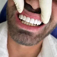 ( ایمپلنت بدون جراحی پانچ از ۶ تومن )|خدمات آرایشگری و زیبایی|اصفهان, سرچشمه|دیوار