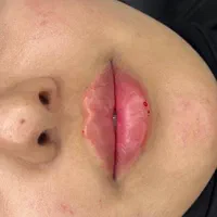 تزریق ژل و بوتاکس و کانتور صورت توسط پزشک|خدمات آرایشگری و زیبایی|فردیس, فردیس|دیوار