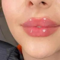 بوتاکس،تزریق ژل،مزوزیرچشم وصورت ،پرسینگ محمدشهر|خدمات آرایشگری و زیبایی|محمدشهر, |دیوار