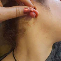درمان گوشت اضافه  بر اثر سوختگی وچاقو، غیره|خدمات آرایشگری و زیبایی|کوهدشت, |دیوار