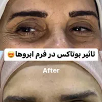 تزریق و آموزش انواع فیلرو بوتاکس|خدمات آرایشگری و زیبایی|مشهد, فرهنگیان (شهرک غرب)|دیوار