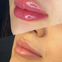 تخفیف ویژه فیلرلب،ژل،انزیم لب،بوتاکس،پی ار پی|خدمات آرایشگری و زیبایی|بندرعباس, |دیوار