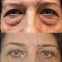 تخفیف بوتاکس، فیلر، بلفاروپلاستی، لاغری و فیشال|خدمات آرایشگری و زیبایی|تهران, ظفر|دیوار