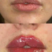 تزریق ژل وبوتاکس|خدمات آرایشگری و زیبایی|گلبهار, |دیوار